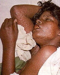 Flat Type Smallpox 